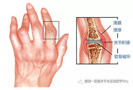 正确认识风湿性关节炎与类风湿关节炎