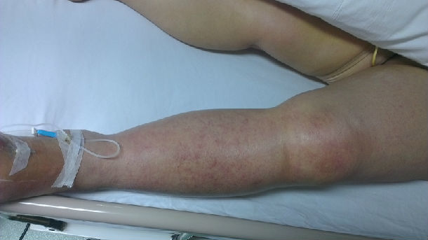 血栓闭塞性脉管炎,足大趾肿胀,坏死糖尿病足下肢动脉硬化闭塞,组织