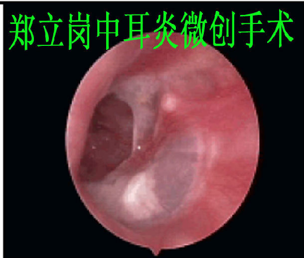 前言:中耳炎微創手術是目前治療慢性化膿性中耳炎及膽脂瘤型中耳炎最