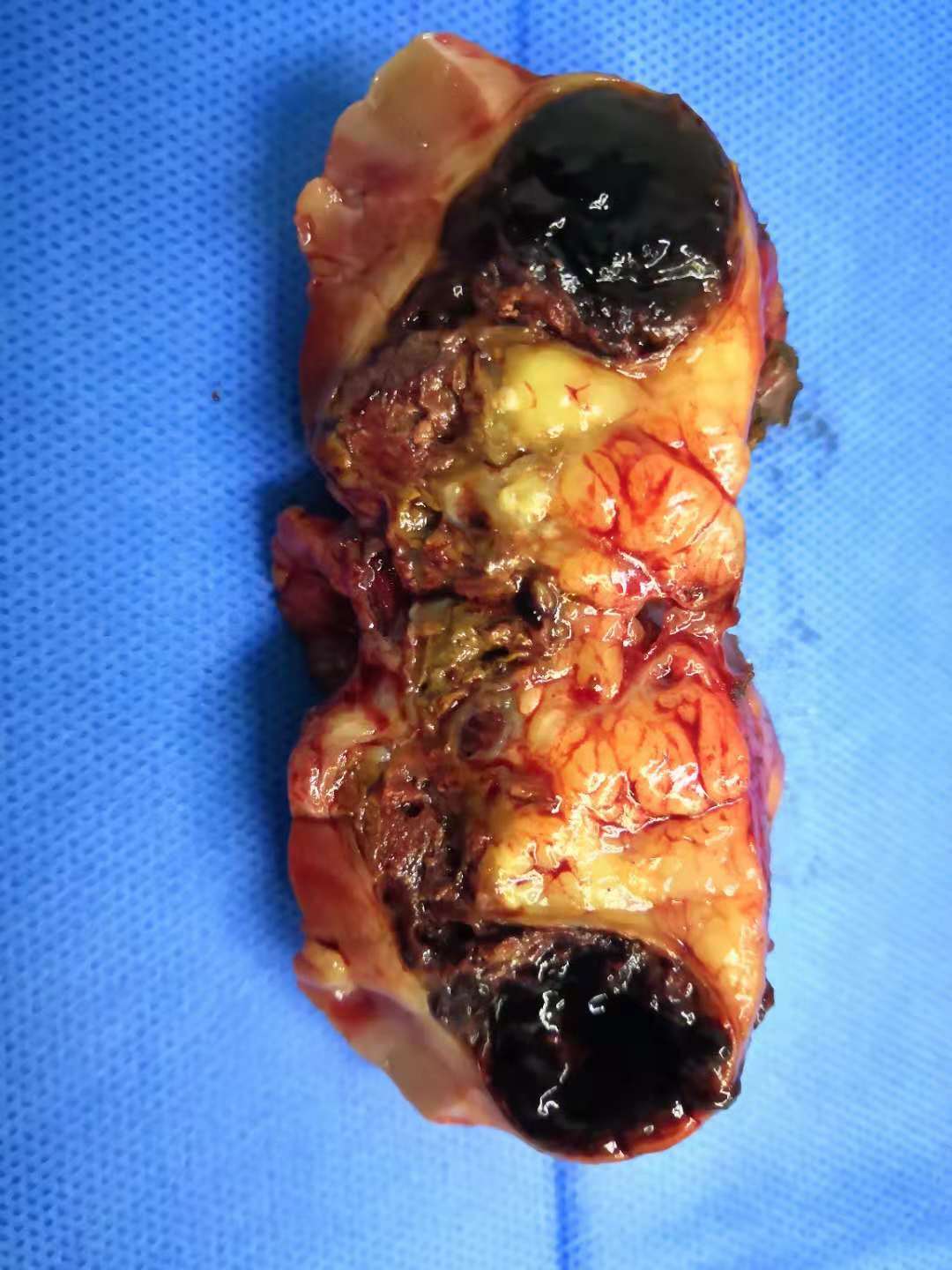 囊性肾癌肾部分切我做过的肾部分切3