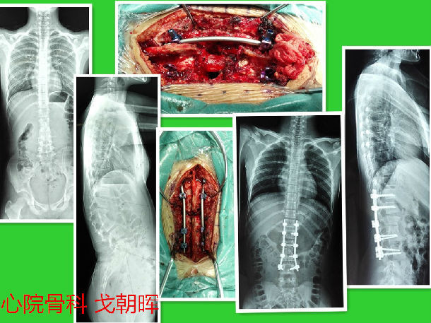 脊柱后凸畸形截骨矫形图片