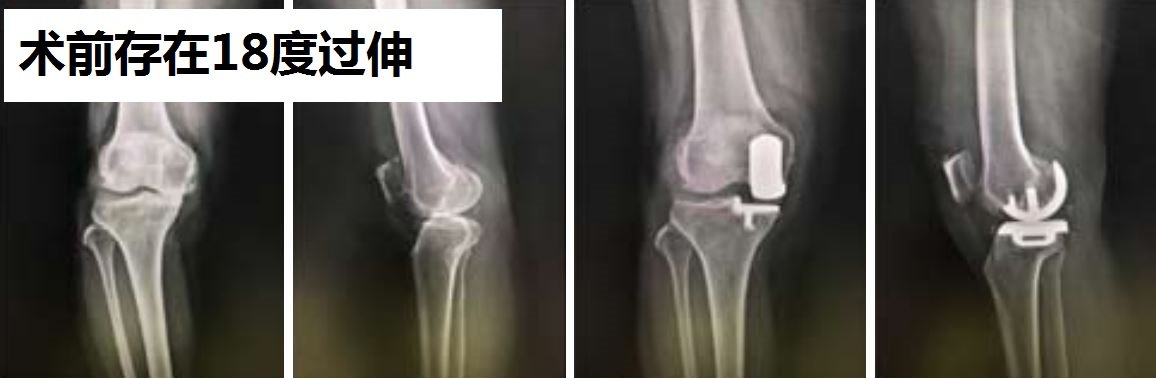 膝关节过伸反屈的骨性关节炎患者能做牛津单髁置换手术么