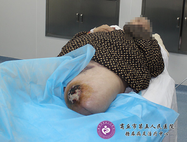 什么情况才需要截肢 xYYBAFu_-viATo-lAAGTPufeeL8519.jpg?_ms_=25e1