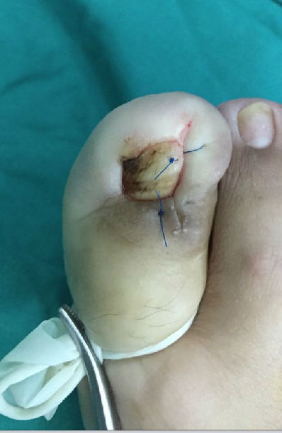 甲沟炎的治疗措施可以是单纯拔甲,可以暂时控制症状,但是多数患者会有