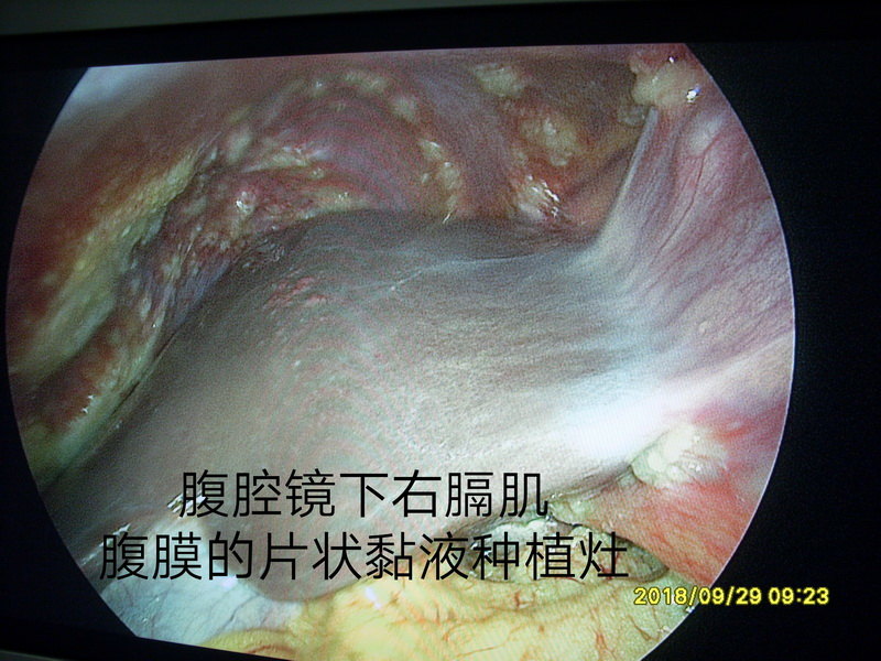 腹膜假黏液瘤病例17右下腹囊腫伴有腹腔廣泛轉移