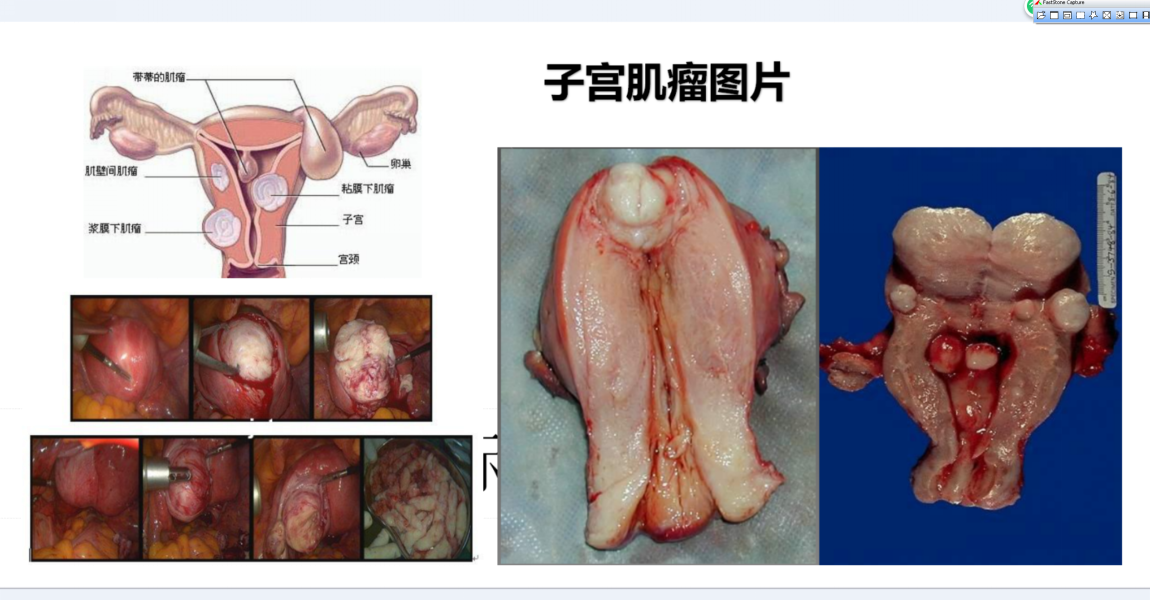 <!--HAODF:8:zigongjiliu-->子宫肌瘤<!--HAODF:/8:zigongjiliu-->.png