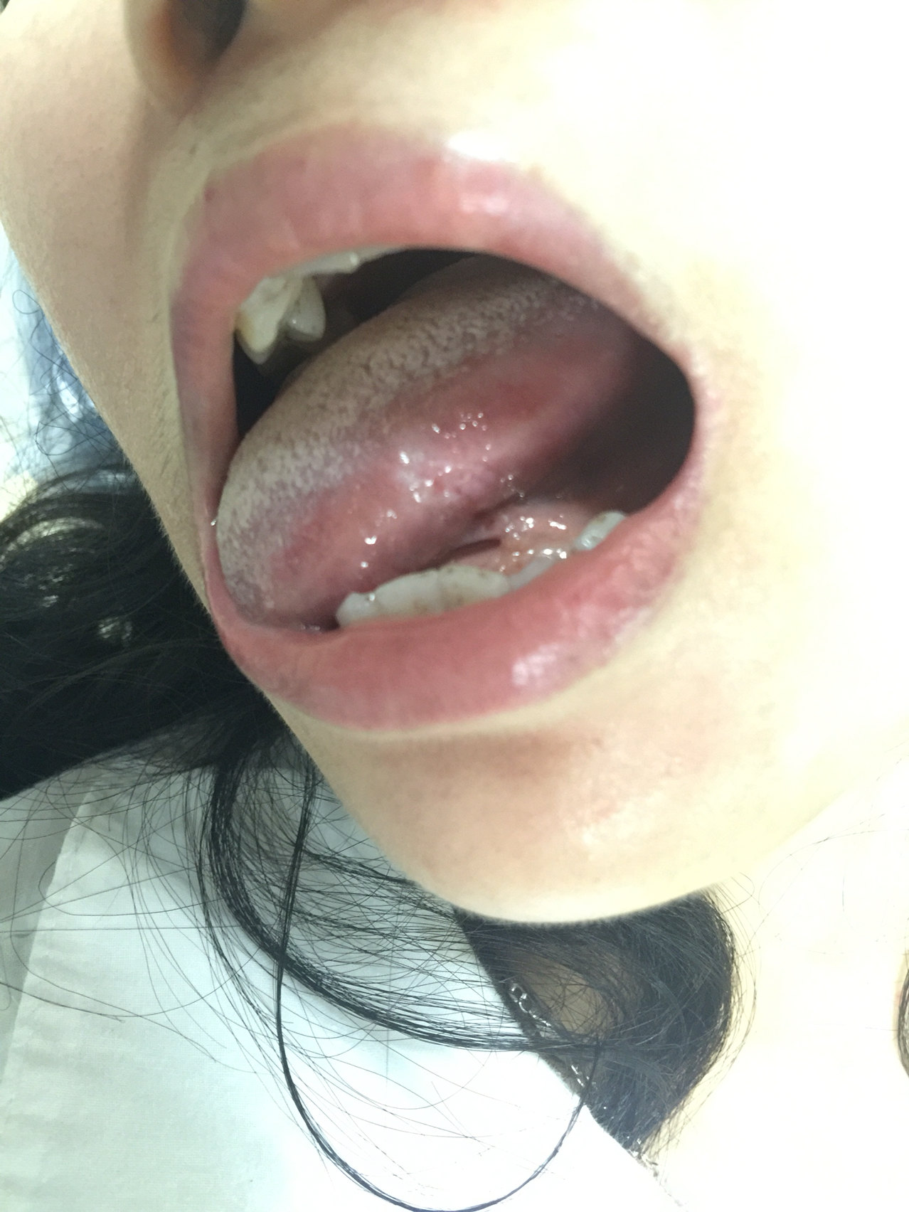 舌癌与非舌癌的图片比较 好大夫在线 舌癌与非舌癌的图片比较 好大夫在线