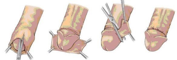 包茎手术后铁环图片图片