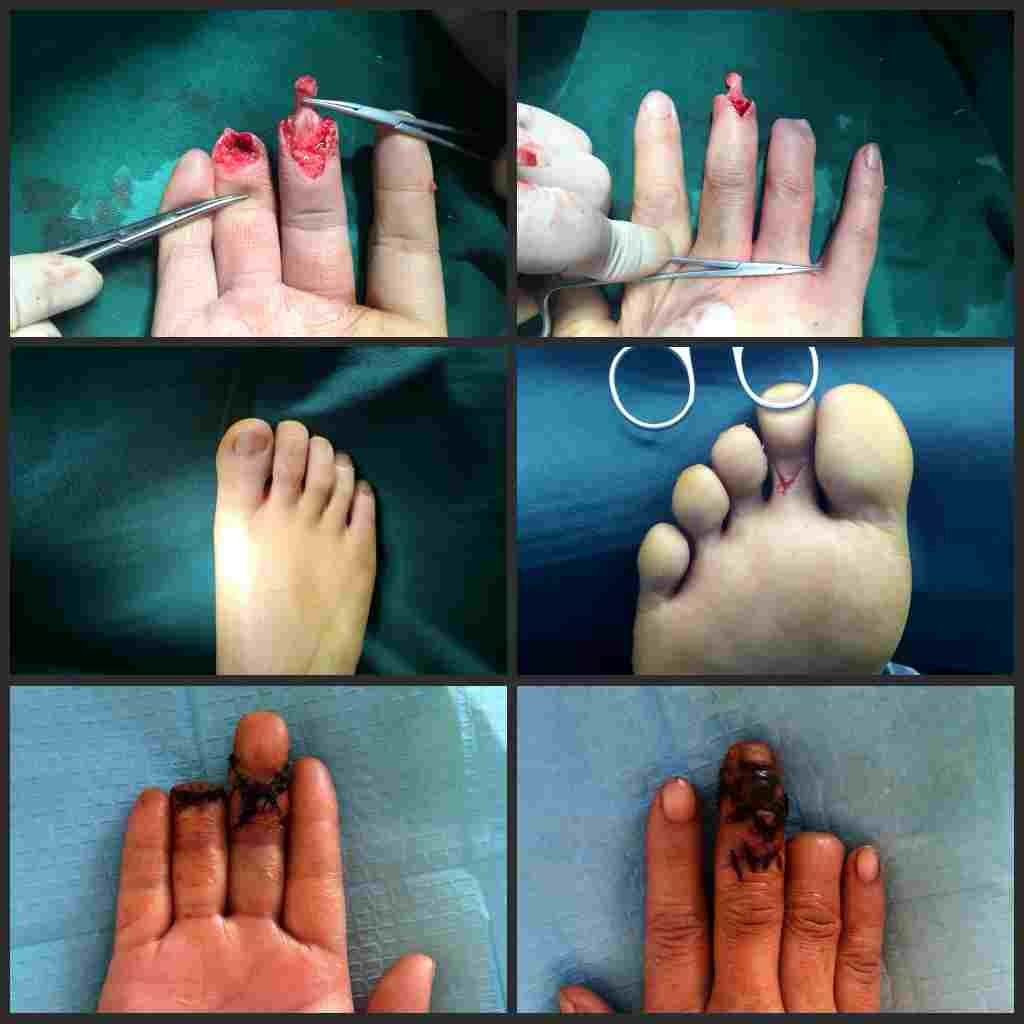 人工指甲盖植入手术图片
