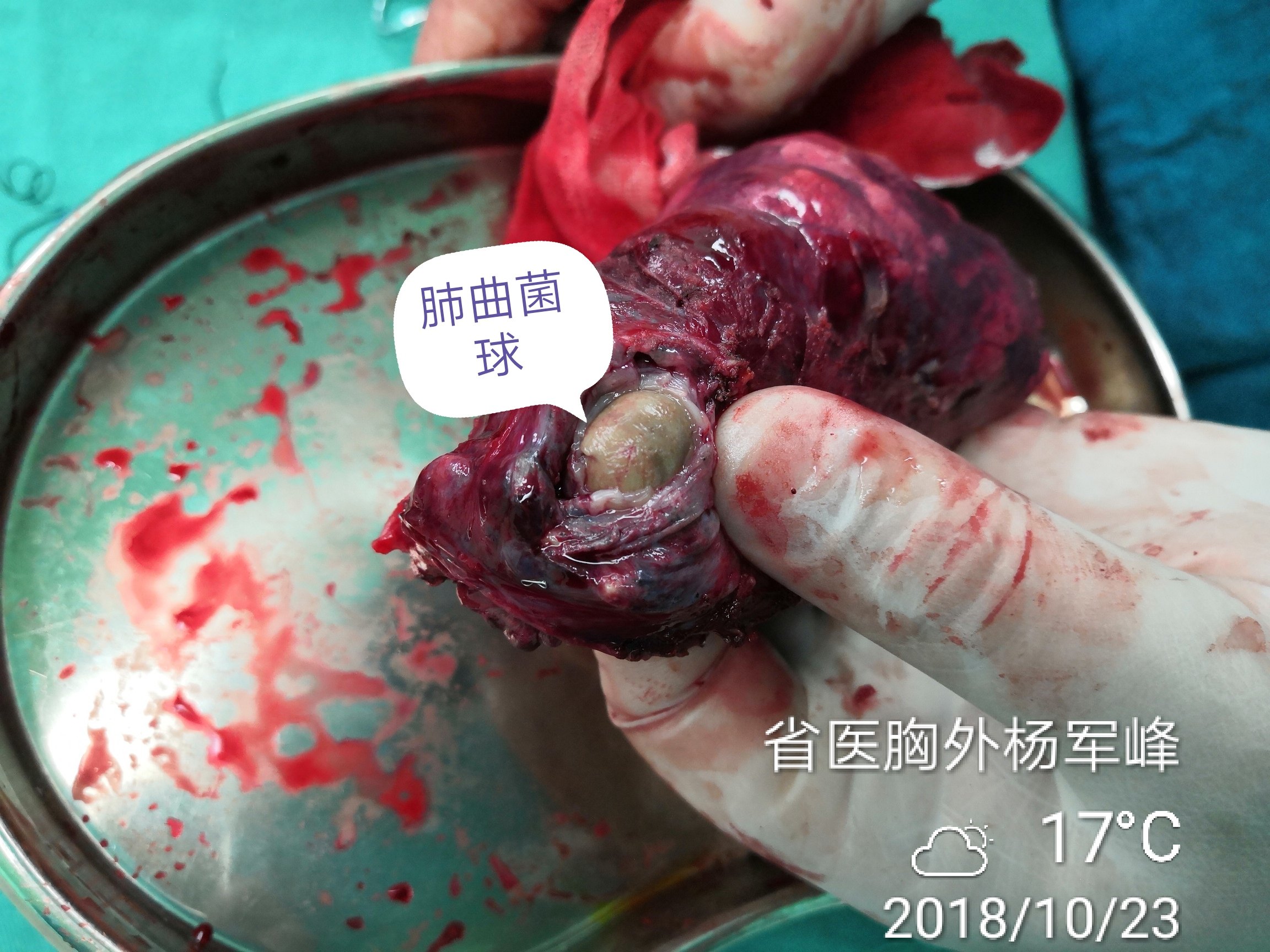 左肺曲菌球病 胸腔镜左上肺叶切除 - 好大夫在线