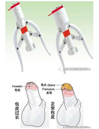 韩式环切包茎手术套环图片