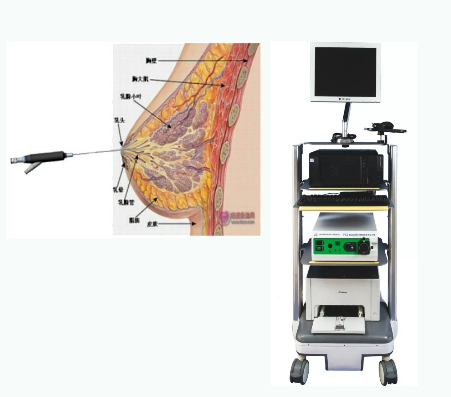 乳腺导管内窥镜解决乳腺大问题