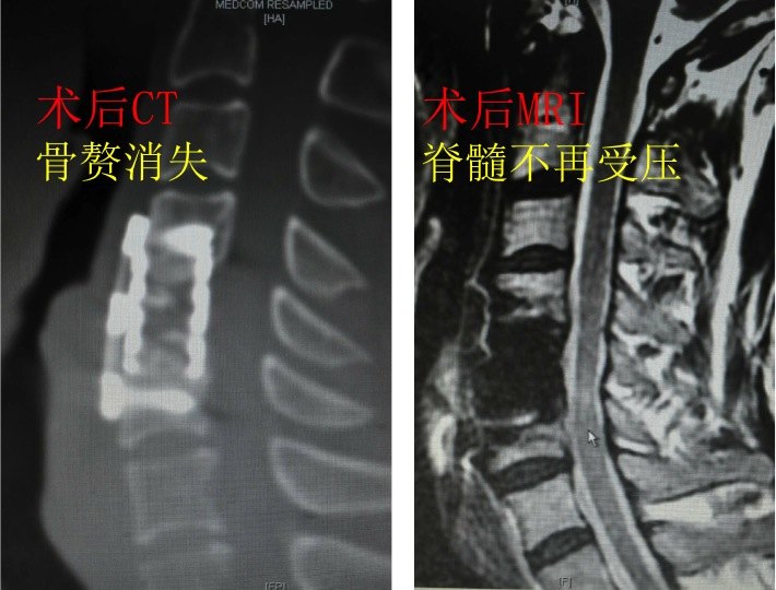 颈椎病脊髓型颈前路四肢麻木无力2月内固定 植骨融合 颈椎病 手术