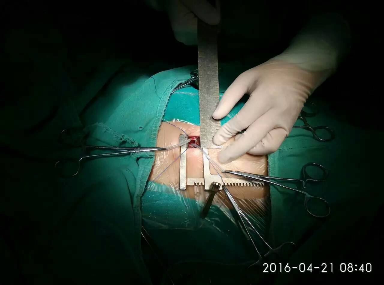 胸骨旁微创小切口封堵中央型房间隔缺损 - 好大夫在线