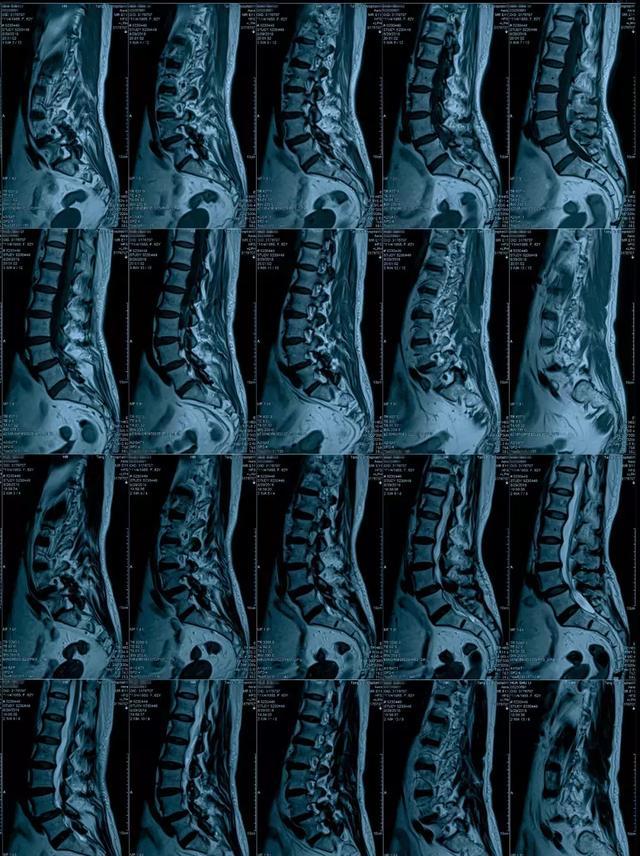 术前影像学检查:腰椎滑脱病人,l4/5的一个退变型滑脱,这个病人的主要
