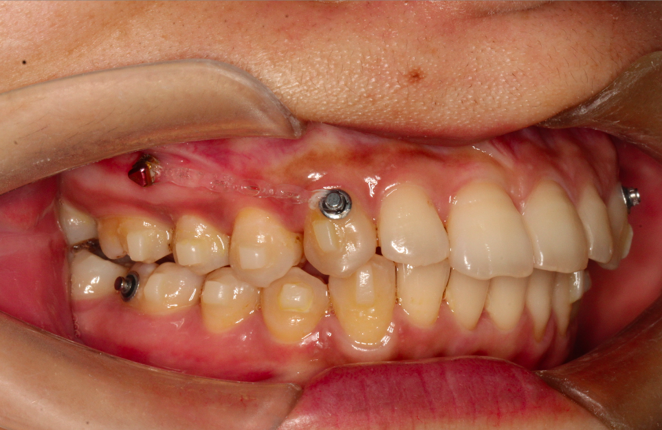 正畸微种植支抗术后注意事项 - 好大夫在线