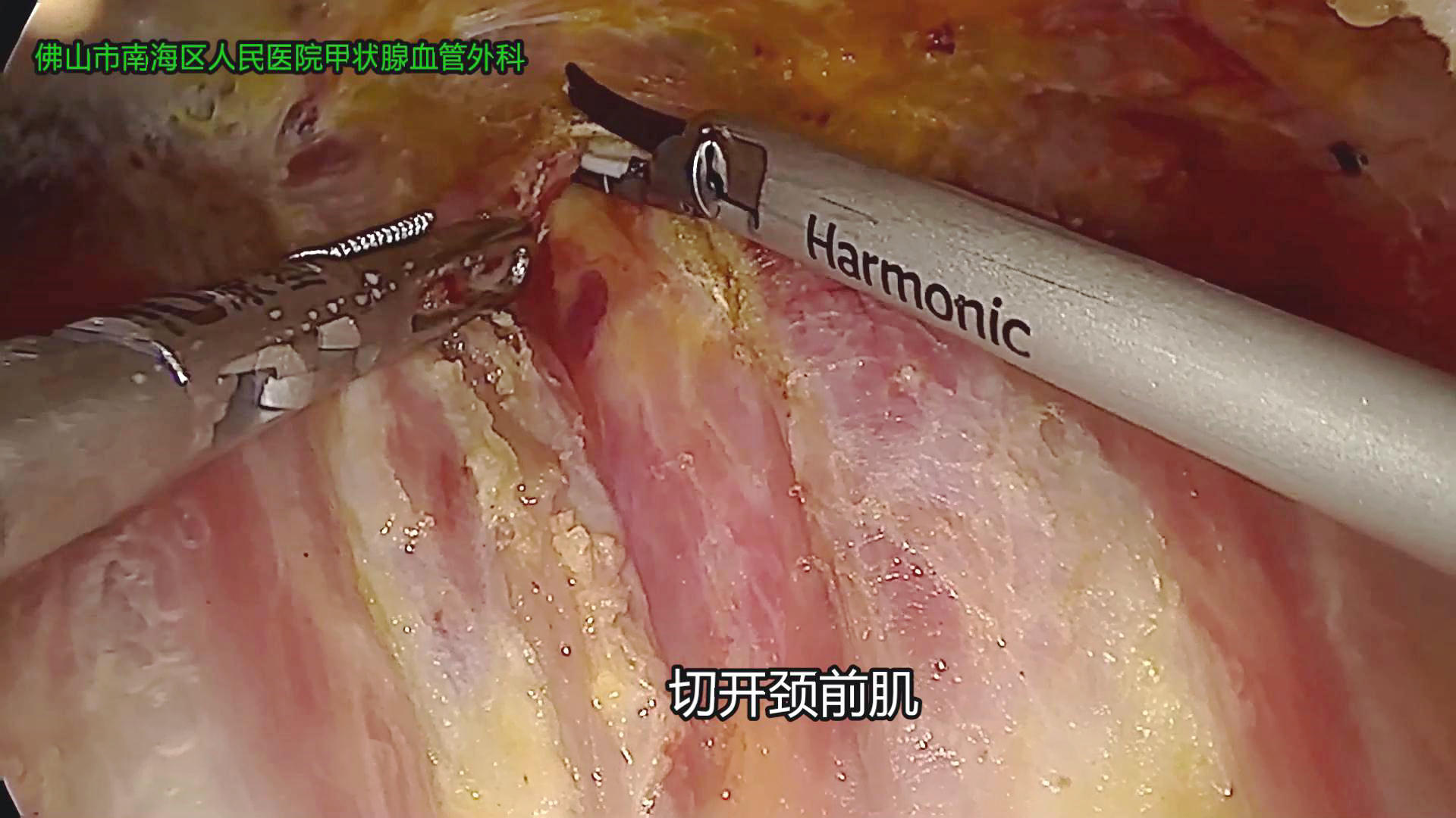 甲狀腺內鏡微創手術過程科普圖片醫學恐懼症勿看