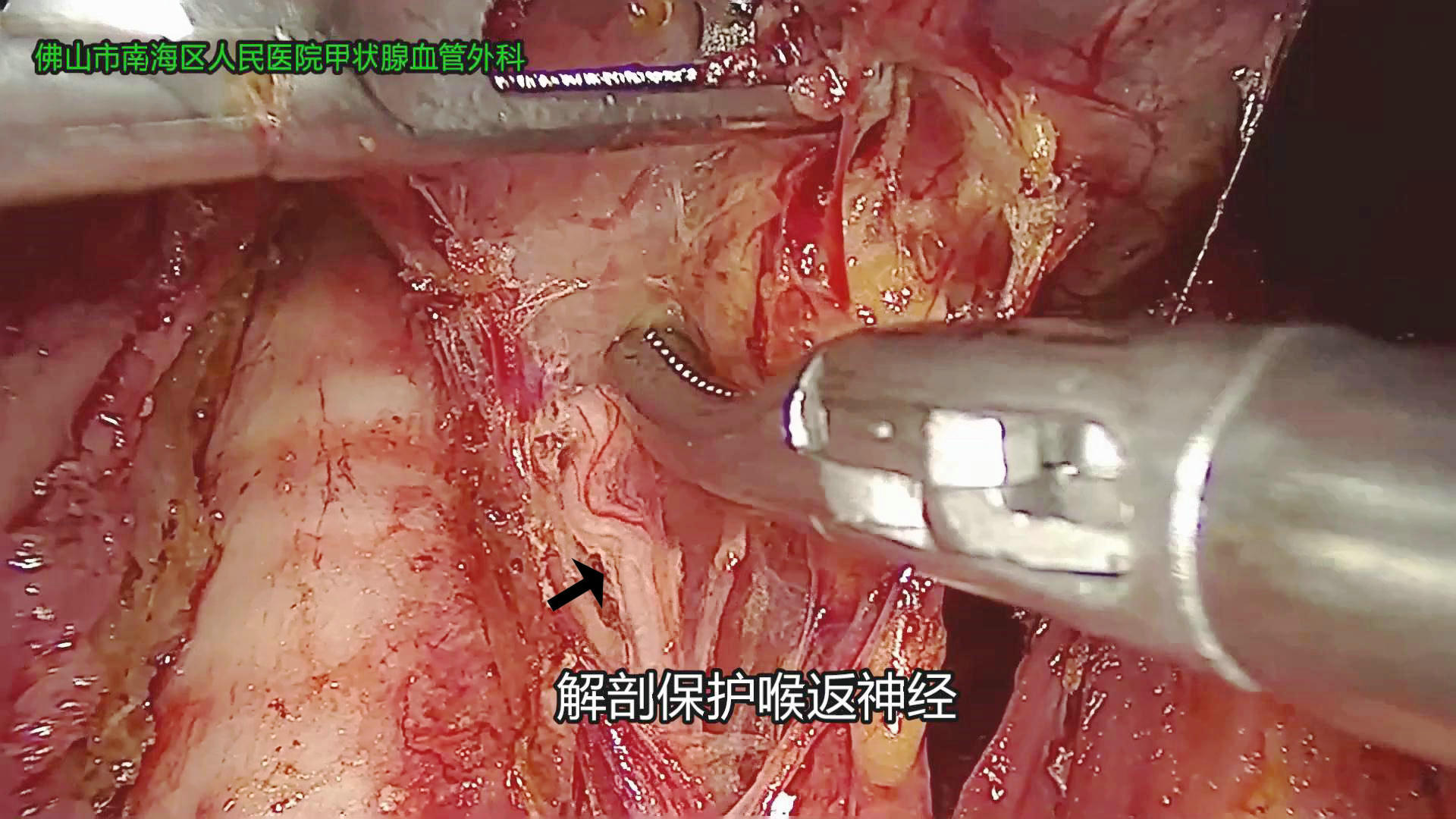 甲状腺内镜微创手术过程(科普图片)——医学恐惧症勿看! - 好大夫在线