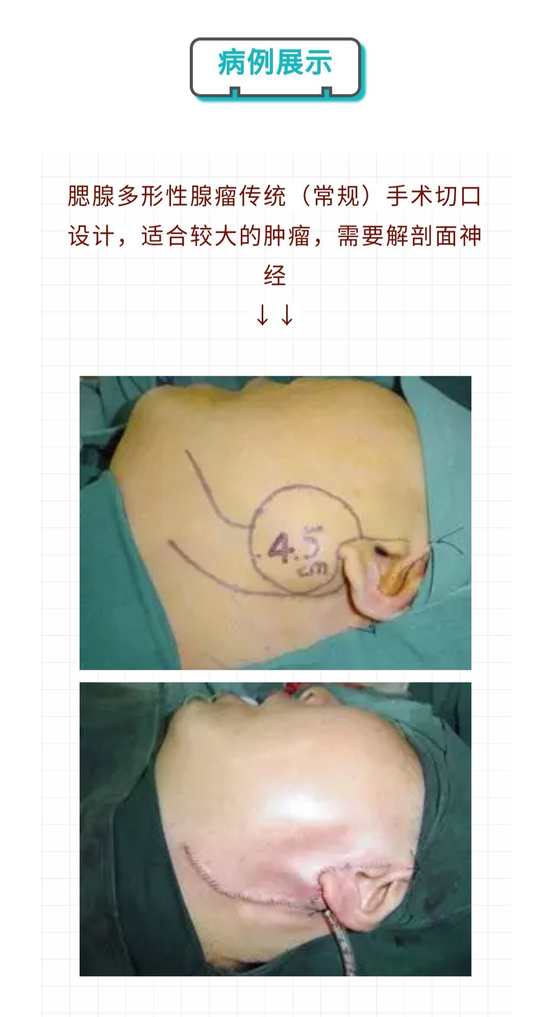 腮腺混合瘤手术后图片图片