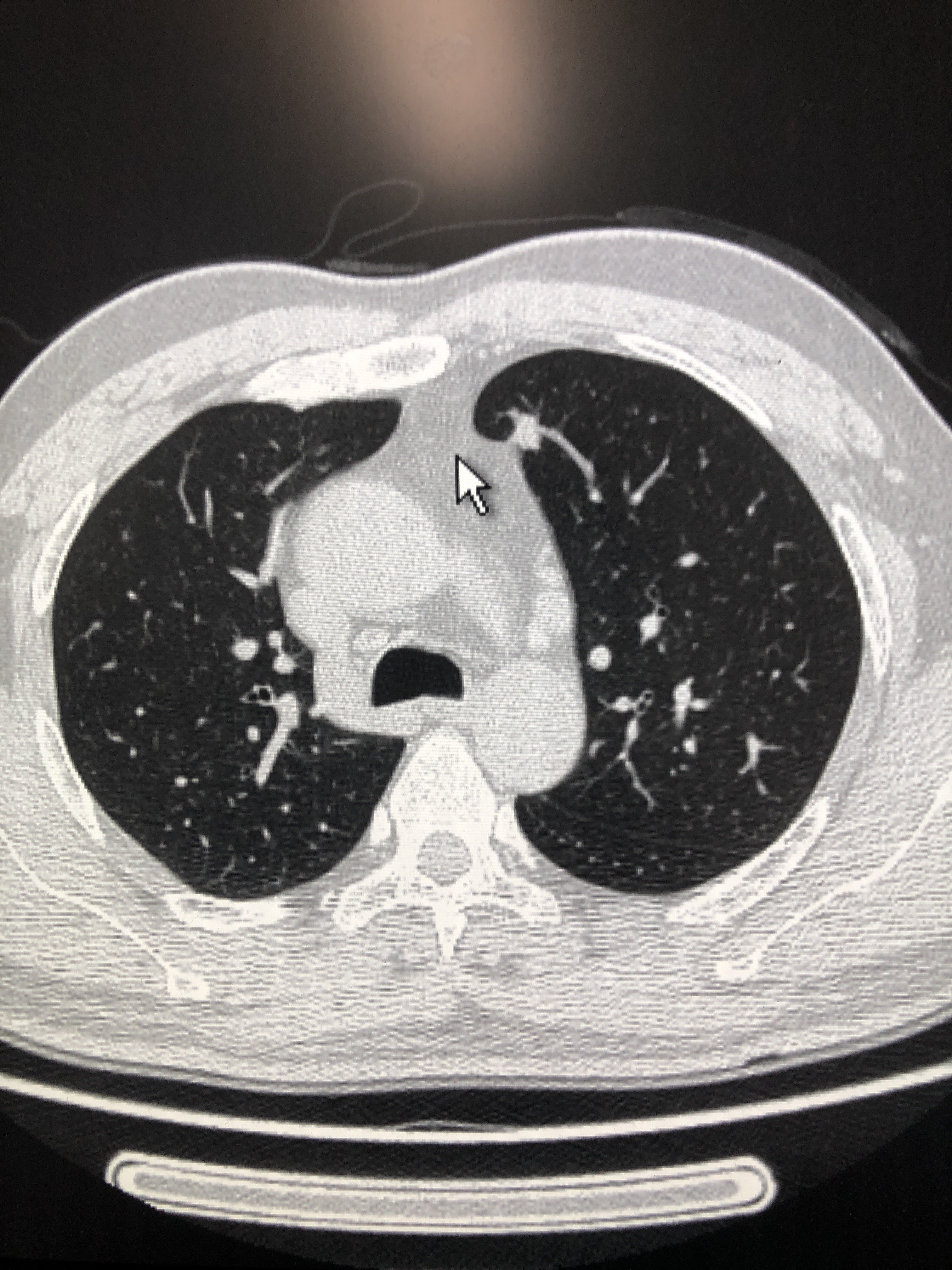 肺图片真实照片图片