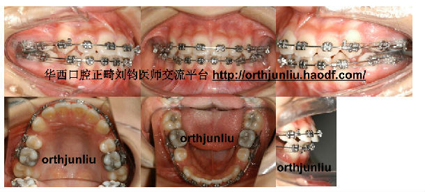 嘴突 拔牙矫治一例 未打骨钉