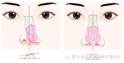 三线减张鼻中隔矫正手术