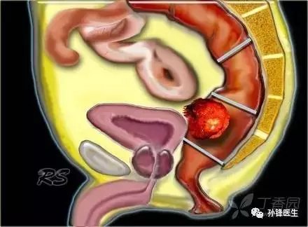 我國直腸癌的發病特點是以中低位多見(位於距齒狀線7cm 以內,腹膜反折