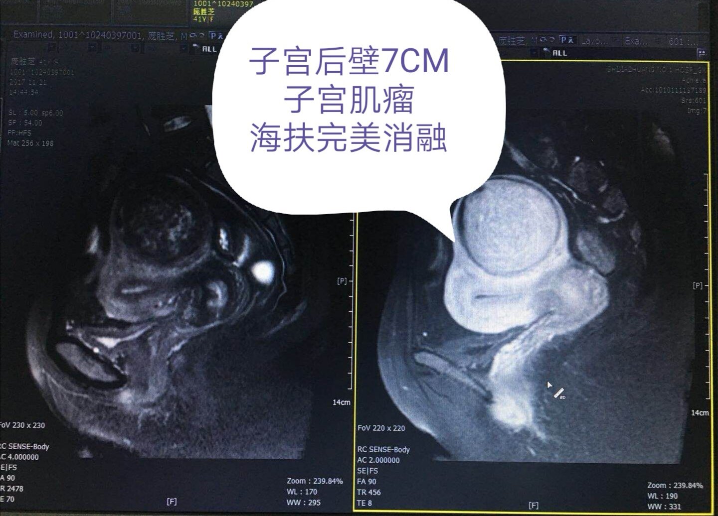 子宫肌瘤做海扶治疗前为什么要做核磁共振检查