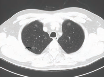磨玻璃结节 磨玻璃结节