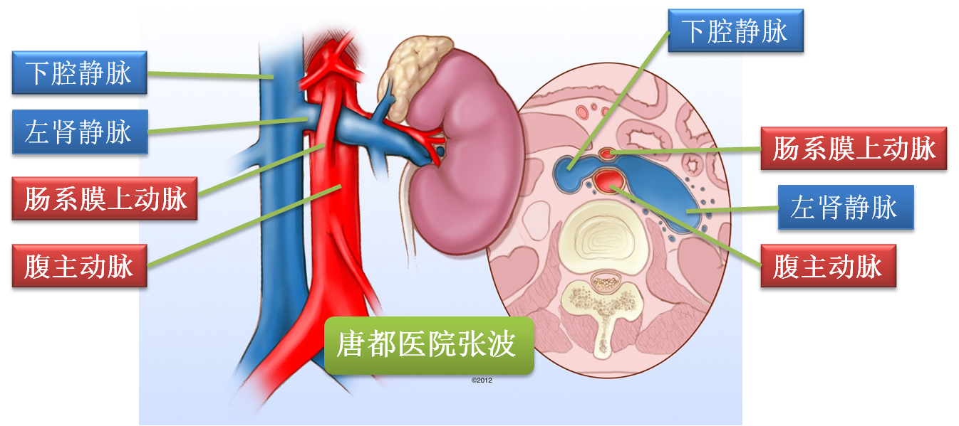 胡桃夹综合征10问 胡桃夹综合征 治疗方法