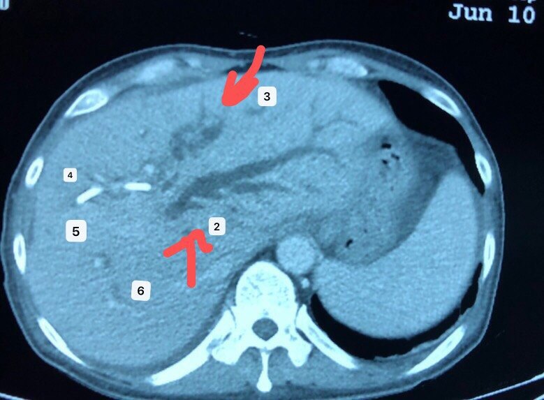 肝门部胆管梗阻治疗是复杂的,介入ptbd是在影像引导下的操作,充分引流