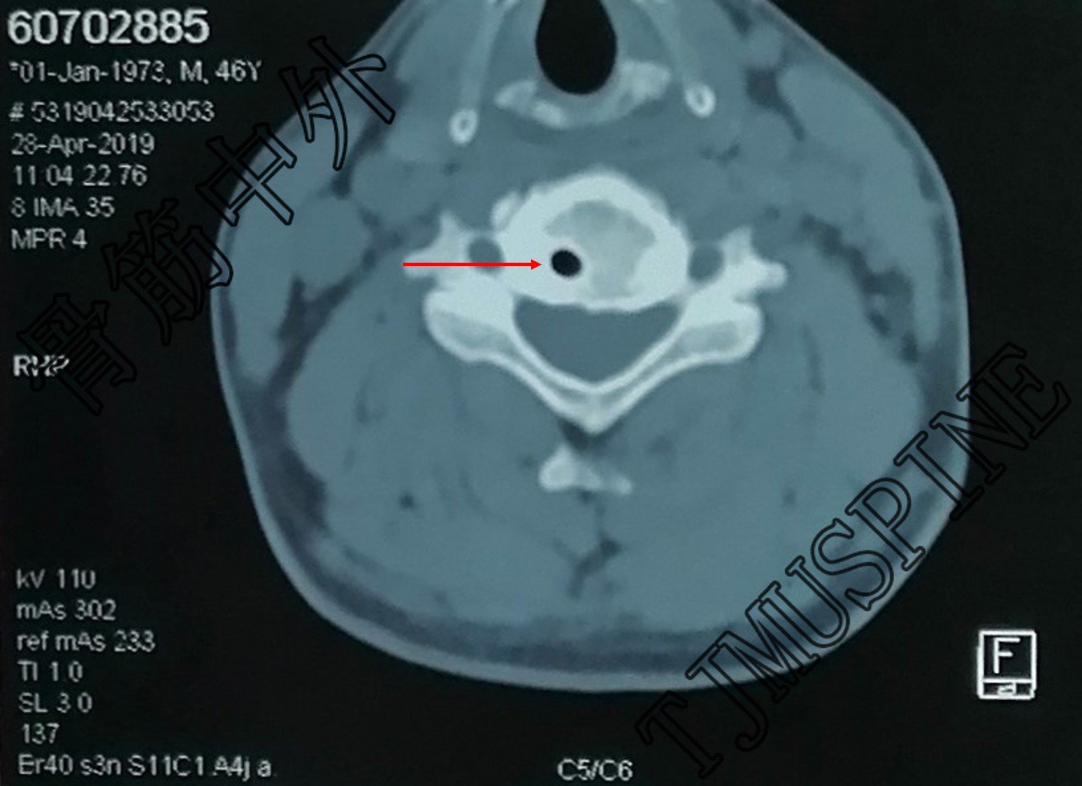ct颈5 箭头示囊肿.jpg