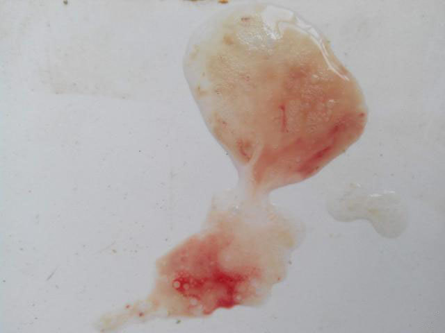 肺癌的白色泡沫痰图片图片