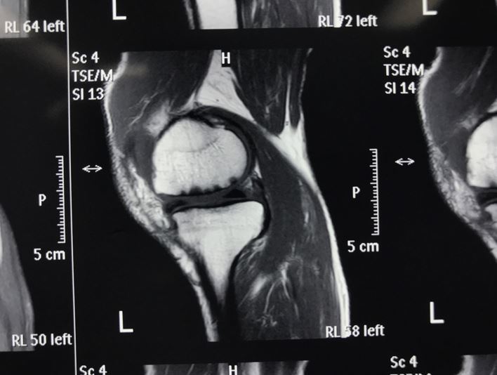 診斷膝關節骨性關節炎一般要做哪些輔助檢查x片mri磁共振片子查血