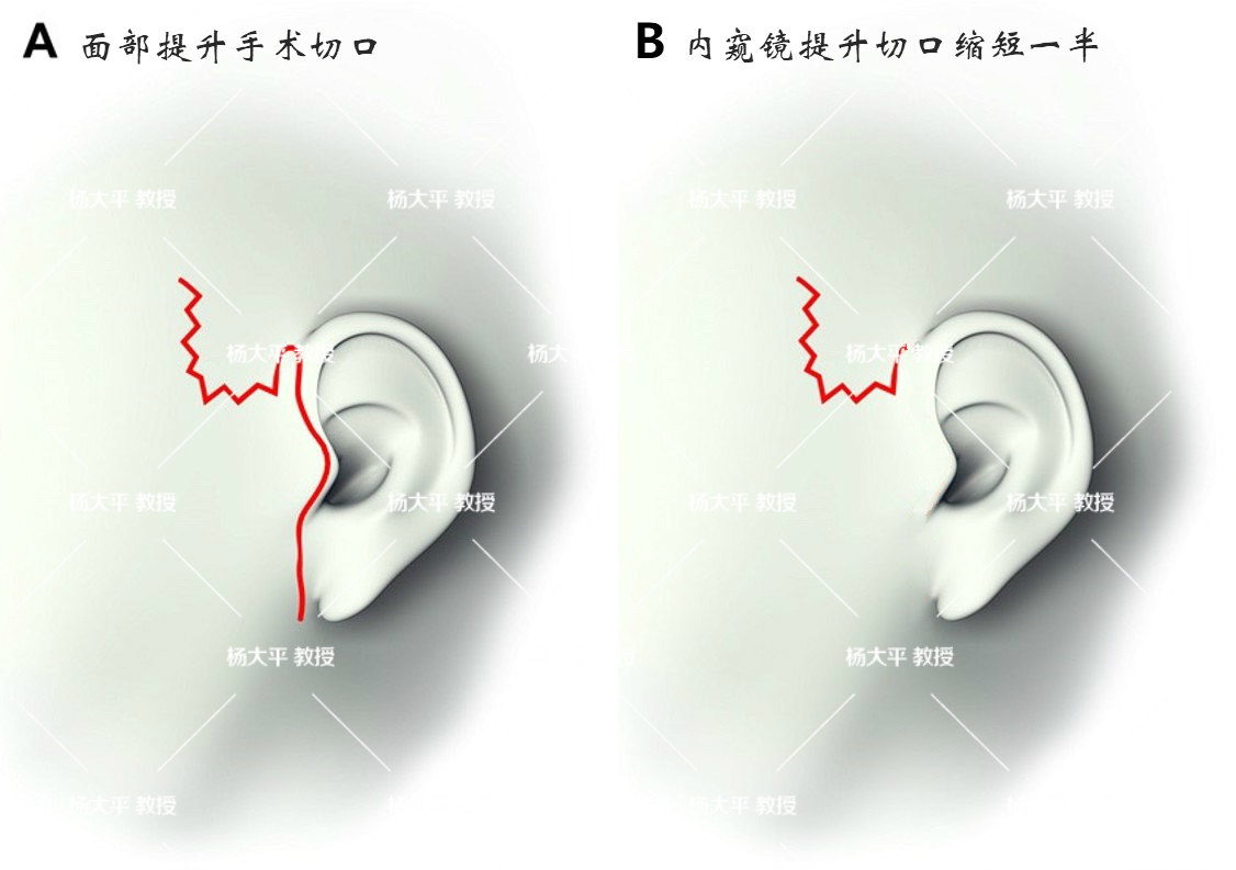 杨大平教授:内窥镜在面部提升手术中的妙用!