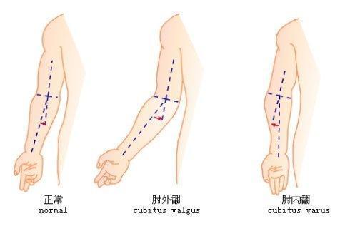 如果孩子骨折后出现肘内翻或肘外翻 需不需要治疗 小儿骨折 治疗方法 症状