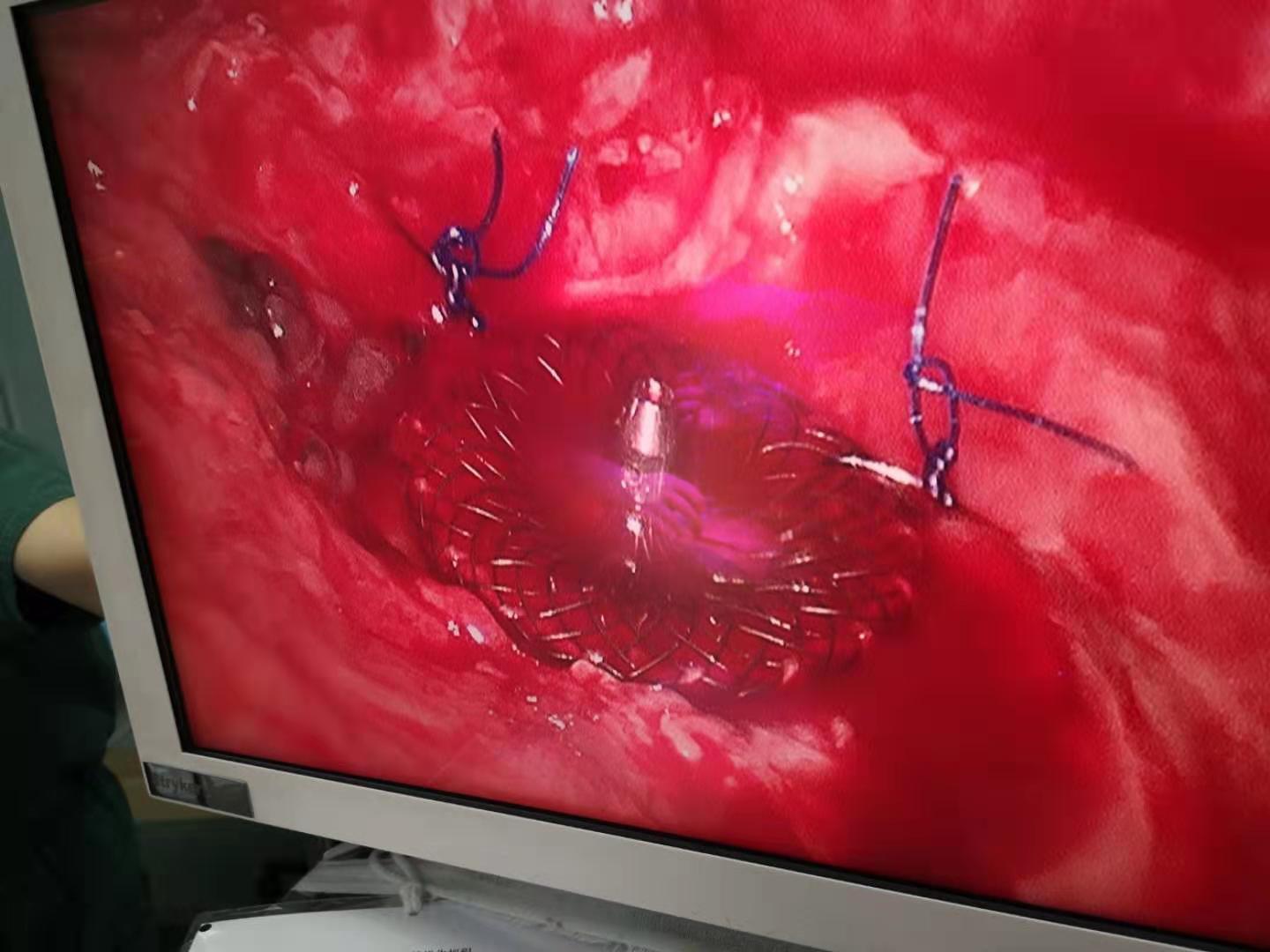 介入封堵治疗支气管胸膜瘘 - 好大夫在线