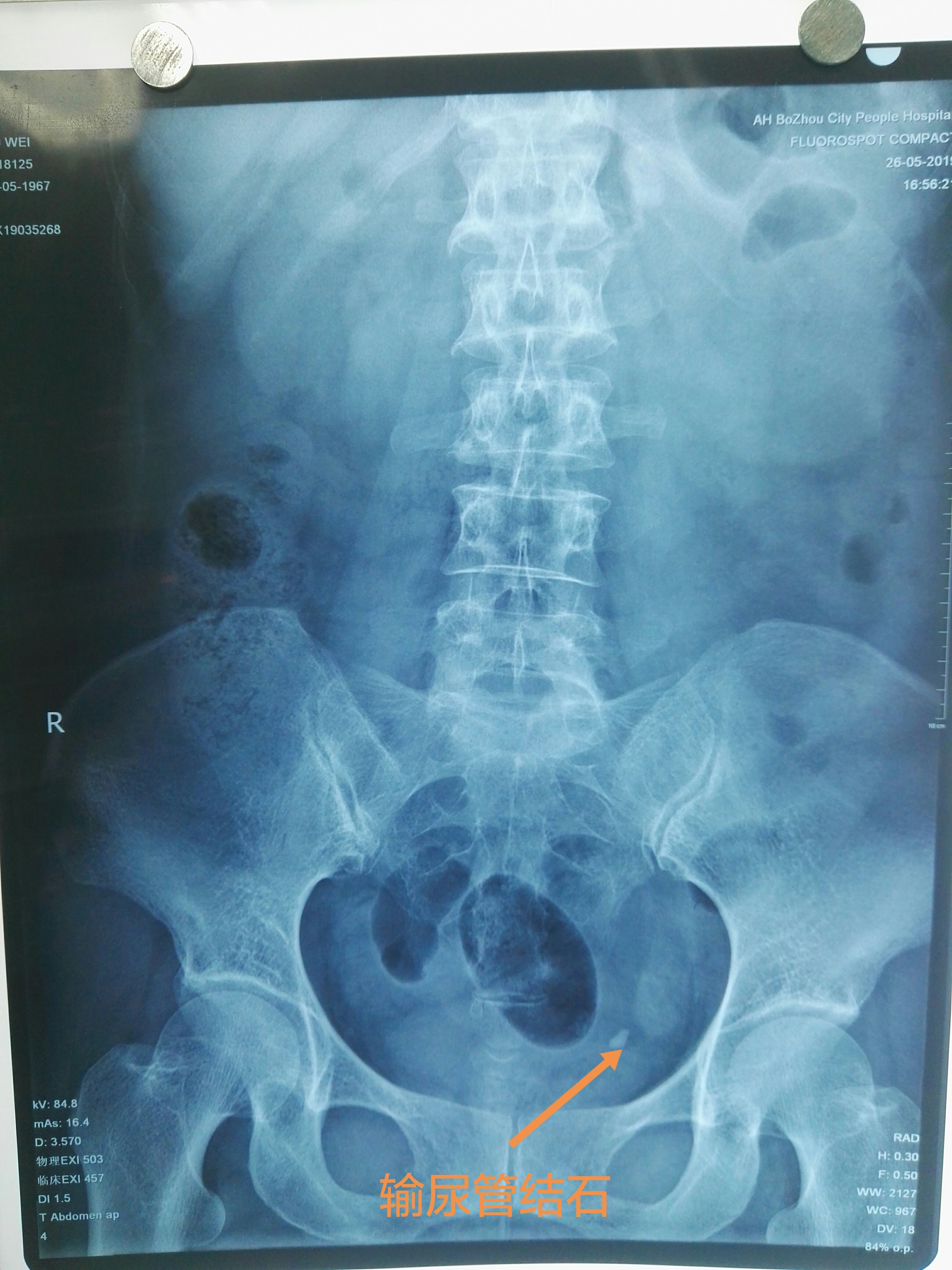 输尿管结石影像图片图片