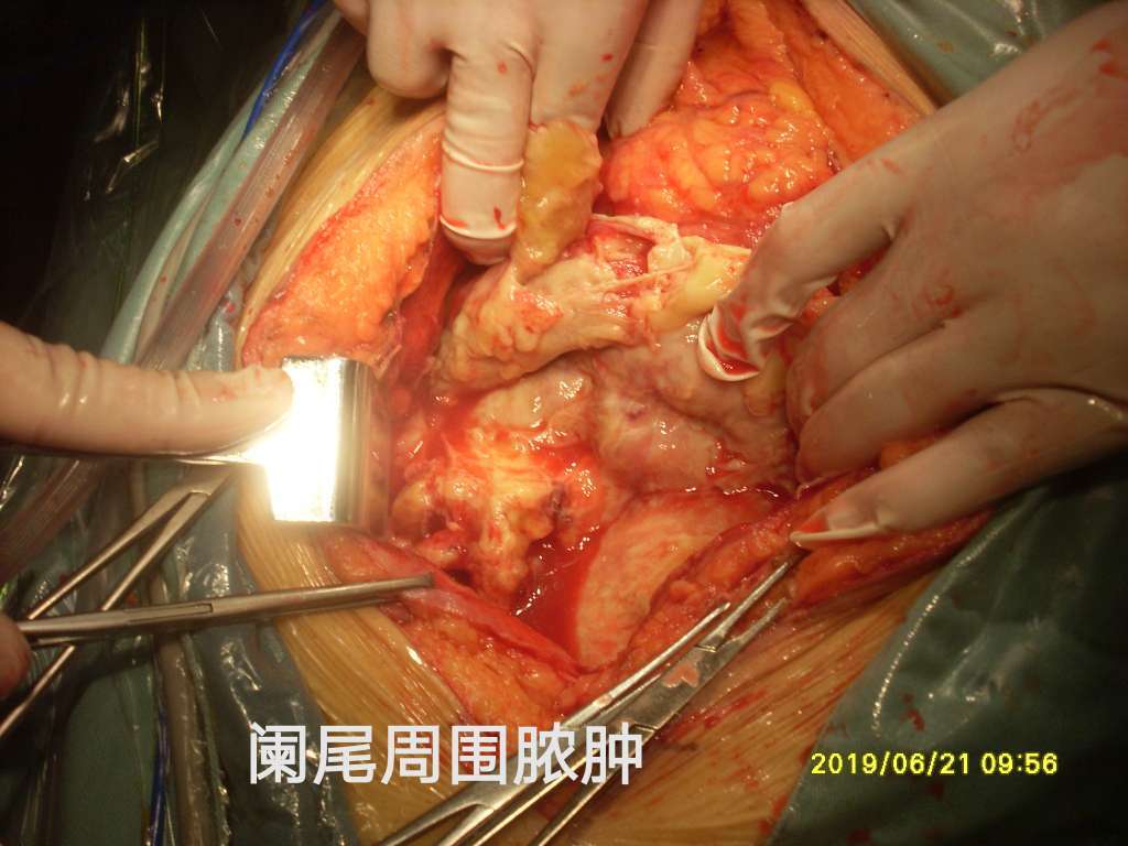 病例82--腹水查因阑尾源性pmp穿孔形成包裹性脓肿