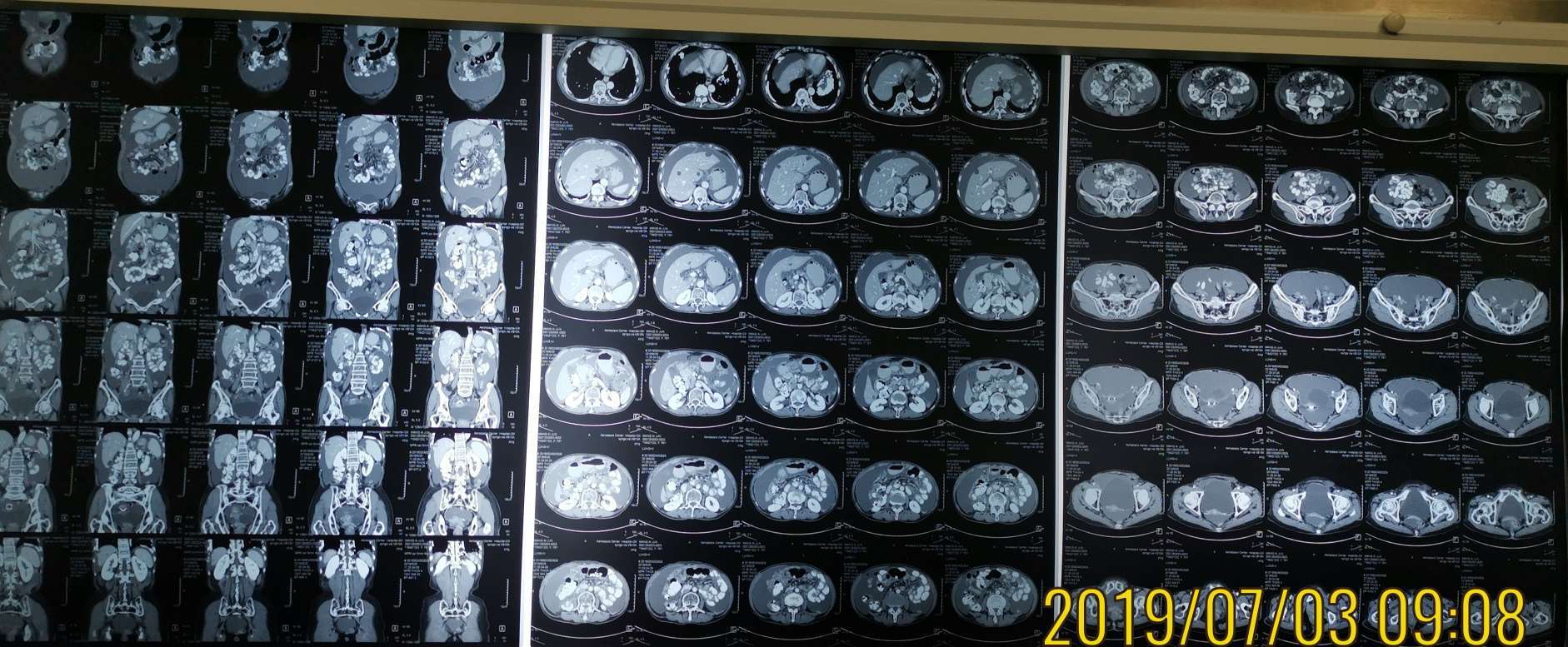 4超声发现腹盆腔积液,ct:大网膜增厚,腹盆腔积液,小肠系膜部分挛缩.