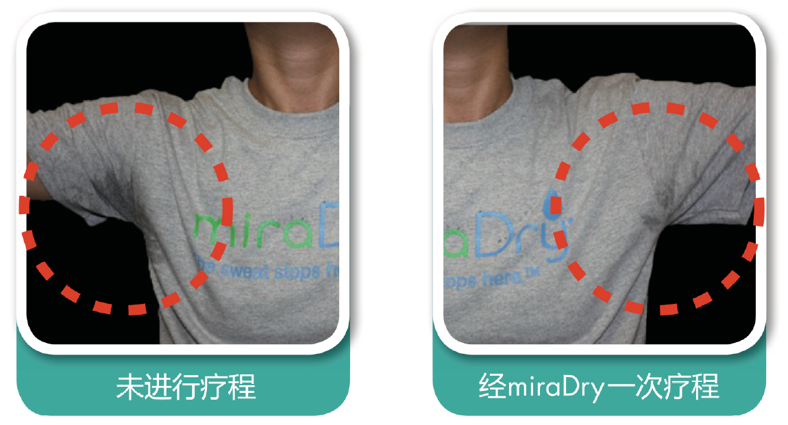 miradry清新微波腋臭治療讓你這個夏天告別尷尬