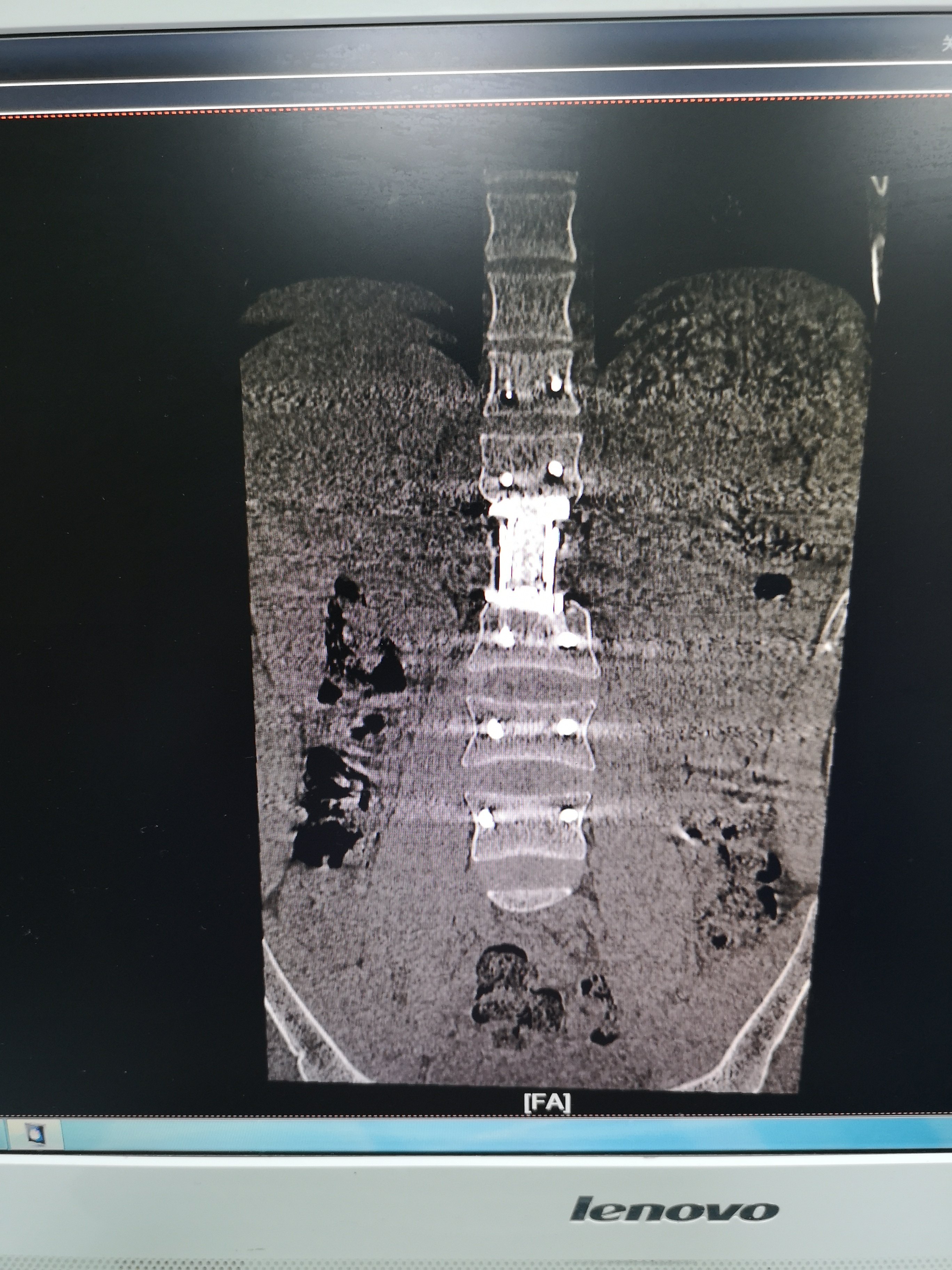 腰椎恶性肿瘤切除术后两年复查无复发,恢复良好 - 好大夫在线