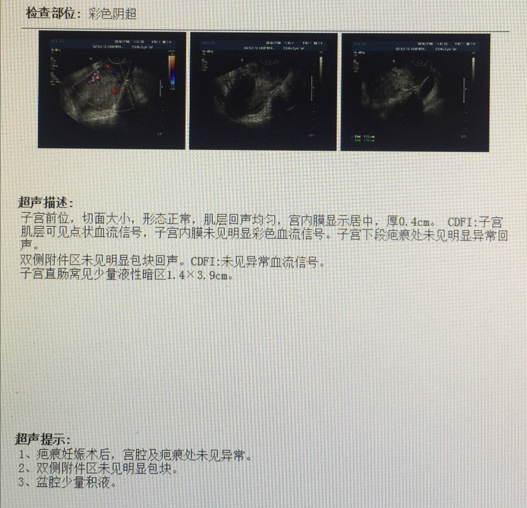 又一例巨大子宮瘢痕憩室妊娠鋌而走險迎來完美結局