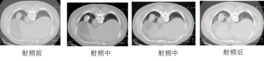 我是广州医科大学附属肿瘤医院肺肿瘤科的薛兴阳医生