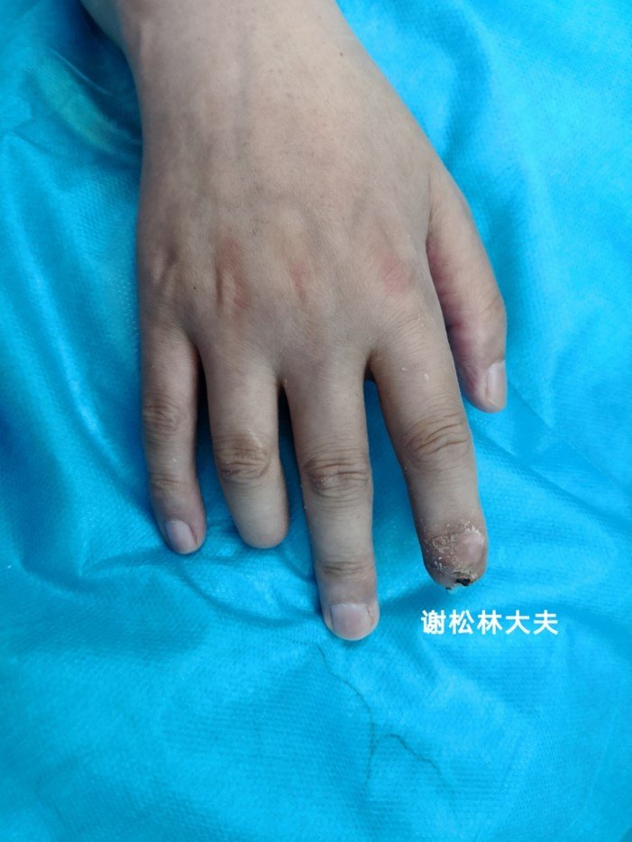 不牺牲足址和足址趾甲真的可以再造出逼真的手指吗? - 好大夫在线