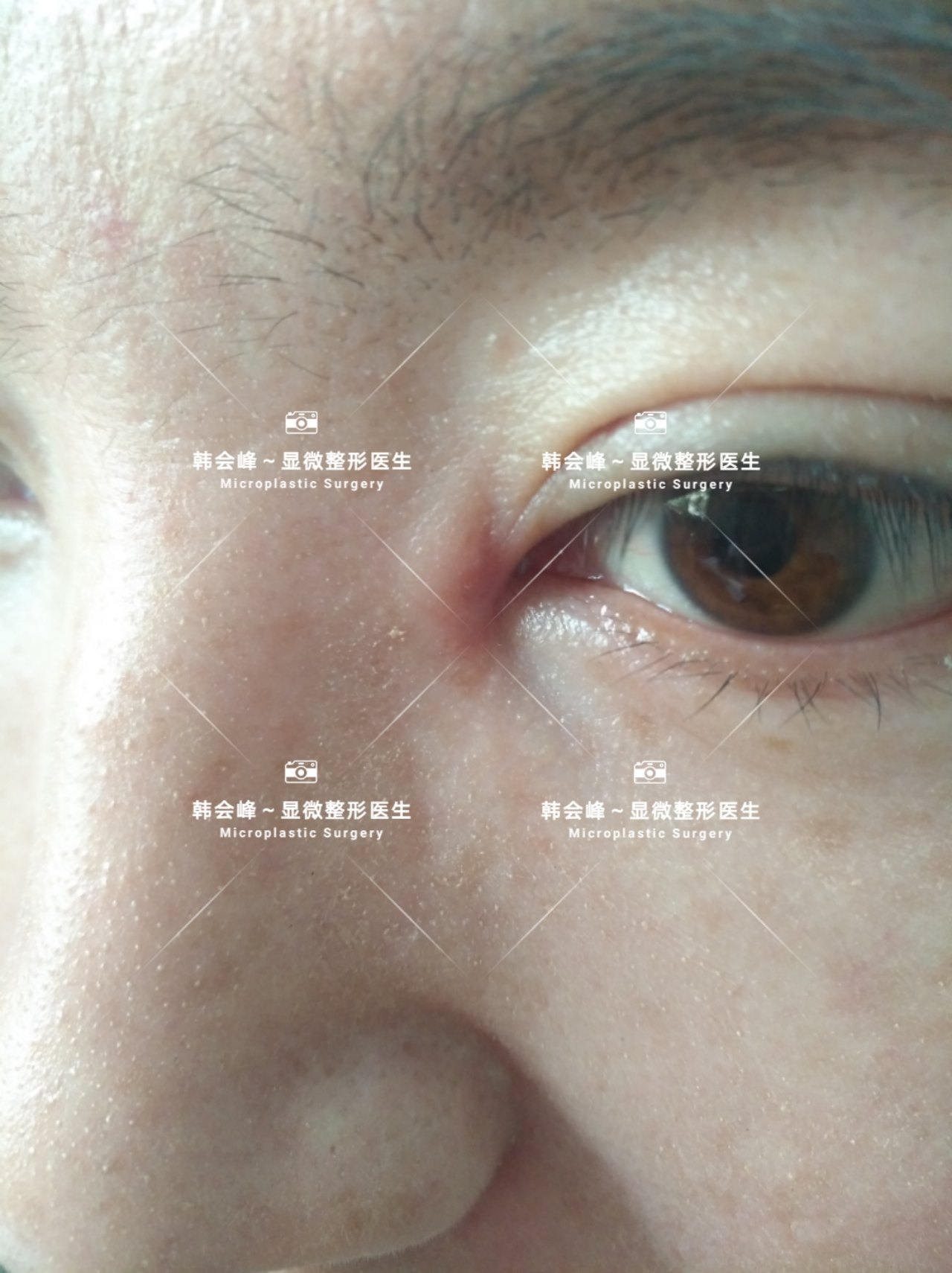 其实不然,这是感染!