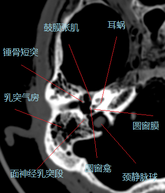 颅骨解剖结构图ct图片