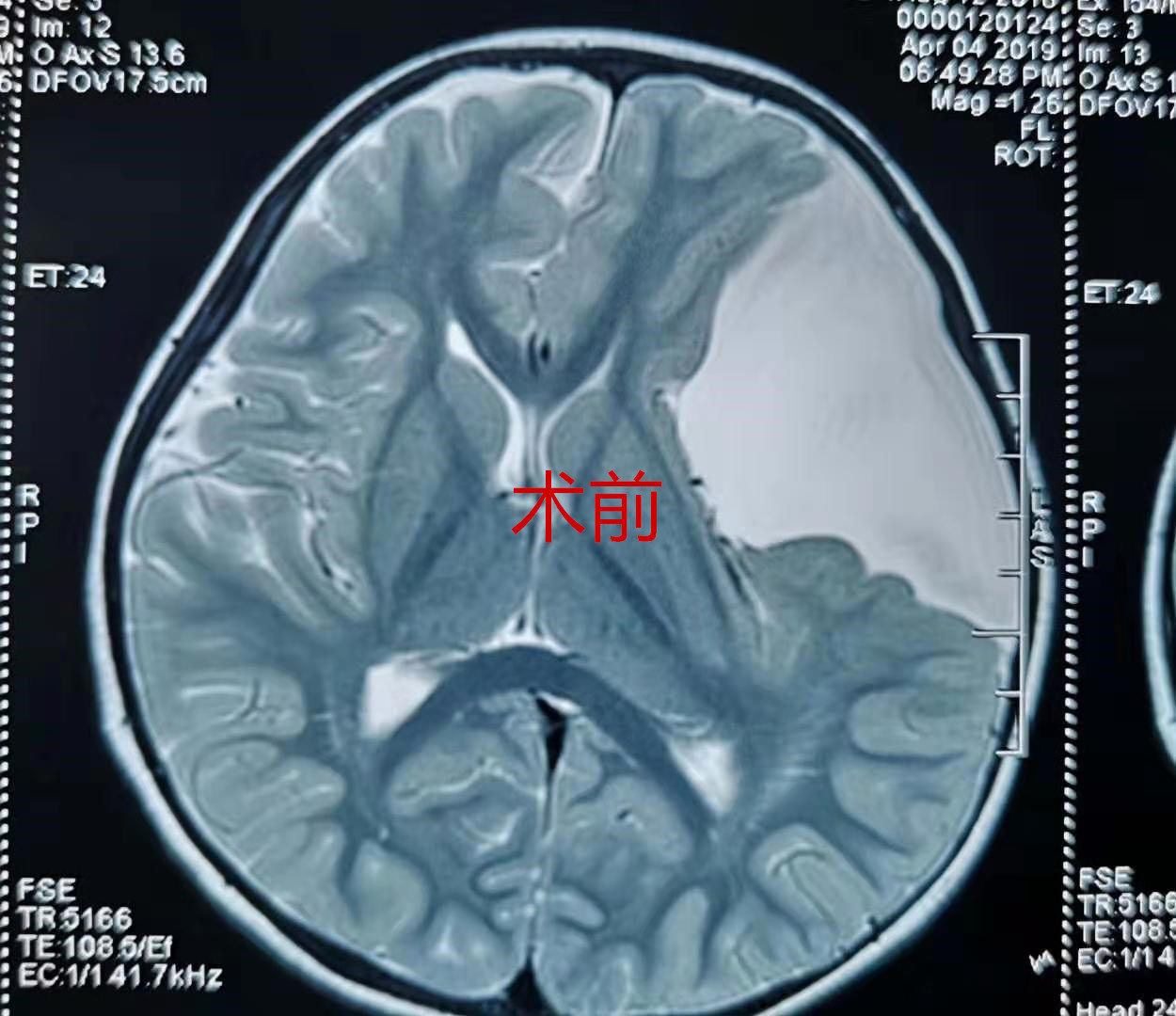 三个月复查的小病友(蛛网膜囊肿) 