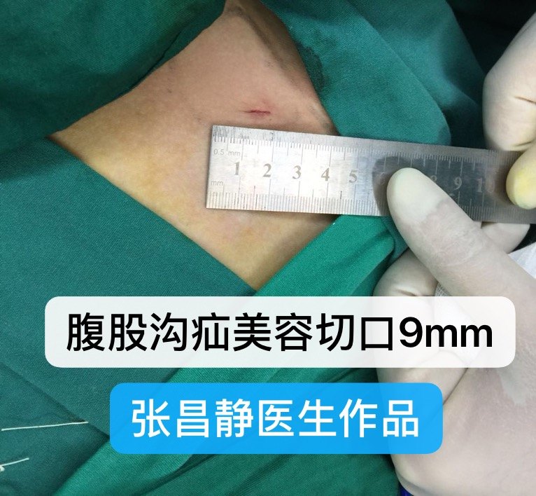 三種小兒腹股溝疝術後效果圖