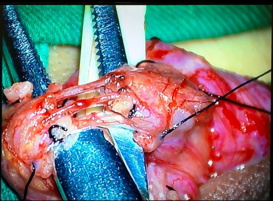 显微手术时代精索静脉曲张手术治疗的金标准